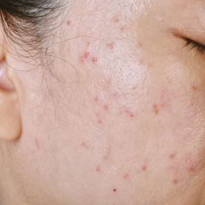 Fagron-FAD_oily_skin