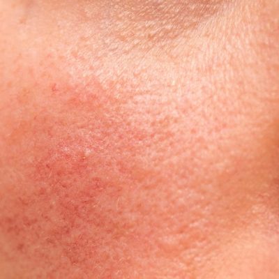 Fagron-FAD_sensitive_skin