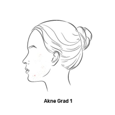 Fagron_Advanced Derma_Akne_Grad 1