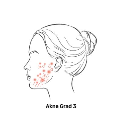 Fagron_Advanced Derma_Akne_Grad 3