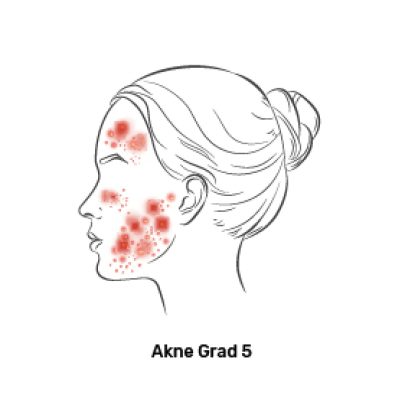 Fagron_Advanced Derma_Akne_Grad 5