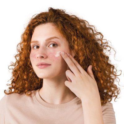 Fagron_Advanced Derma_Akne_junge Frau