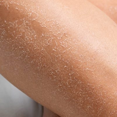 Fagron_Advanced Derma_Xerose_Ellenbogen